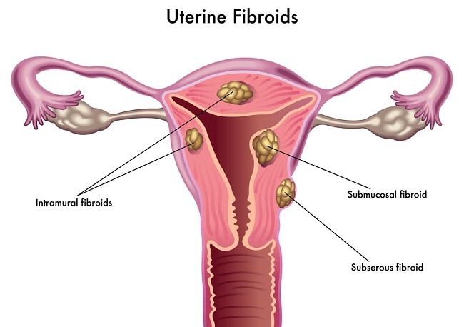 Fibroid Uterus