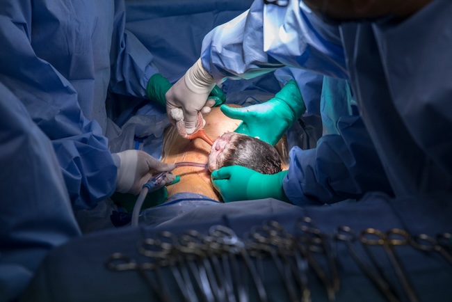 Praktik Berbasis Bukti untuk Mengoptimalkan Luaran Seksio Sesarea