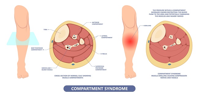 Sindrom Kompartemen, Compartment Syndrome