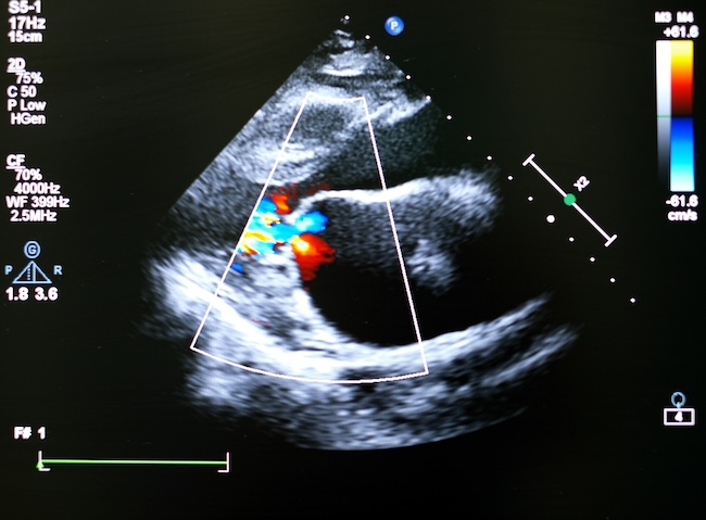 Pedoman Penanganan Kelainan Katup Jantung