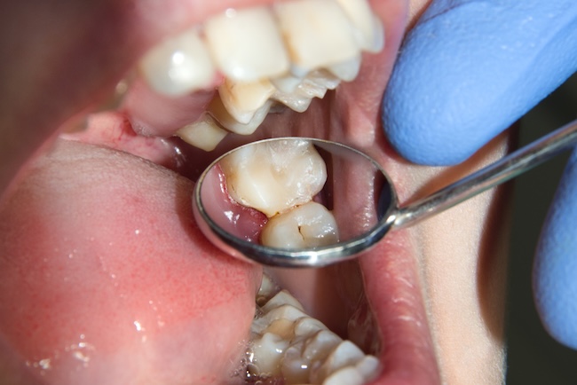 Pedoman Tata Laksana Penyakit Periodontal