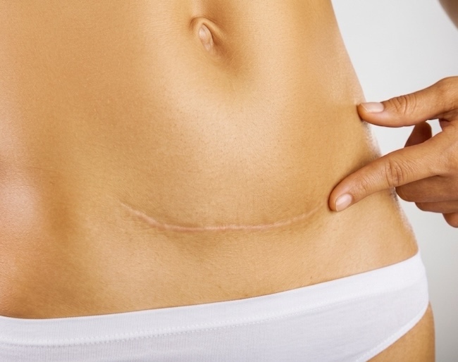 Suture Lebih Unggul dibandingkan Stapler pada Sectio Caesarean