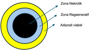 Pembagian Zona pada Lipoaspirat
