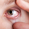 Migraine dan Risiko Dry Eye Syndrome