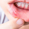 Apakah Defisiensi Vitamin D Merupakan Faktor Risiko Recurrent Aphthous Stomatitis?