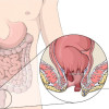 Peran Micronized Purified Flavonoid Fraction (MPFF) dalam Manajemen Hemoroid