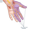 Injeksi Kortikosteroid dengan Panduan USG untuk Terapi Carpal Tunnel Syndrome