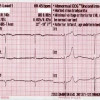 Interpretasi EKG secara Digital dapat Menyebabkan Kesalahan Medis