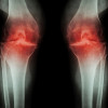 Glukosamin dan Kondroitin dalam Penatalaksanaan Osteoarthritis