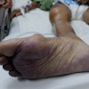 Risiko Acute Limb Ischemia akibat COVID-19