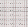 Skoring untuk Deteksi Stroke karena Atrial Fibrilasi – Telaah Jurnal