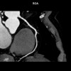 Penggunaan Coronary CT Angiography pada Angina Pektoris Stabil
