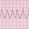 Radioablasi, Potensi Terapi Baru untuk Ventricular Tachycardia