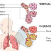 Kortikosteroid untuk Penanganan Pneumonia Komuniti