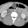 Manajemen Trauma Tumpul Limpa: Operatif Vs Nonoperatif