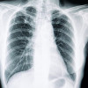 Fibrosis Paru Pada Pasien COVID-19