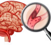 Perbandingan Kombinasi Ticagrelor dan Aspirin atau Aspirin Tunggal untuk Stroke Iskemik Akut – Telaah Jurnal Alomedika