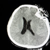 Pemeriksaan Biomarker untuk Cedera Otak Traumatik
