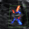 Rasio Serum Prenatal sFlt-1/PIGF Sebagai Prediktor IUGR