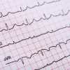 Memahami Gelombang P dalam EKG