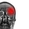 Penanganan Awal pada Stroke Iskemik Akut