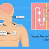 Stimulasi Nervus Vagus untuk Penatalaksanaan Epilepsi