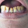 Faktor Penyebab dan Cara Pencegahan Erosi Gigi