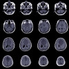 Manajemen Meningioma Insidental