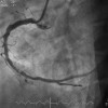 Angioplasti Tidak Lagi Direkomendasikan untuk Penyakit Arteri Koroner Stabil – Artikel Terkini!