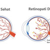 Efikasi Fenofibrate pada Retinopati Diabetes – Artikel Terkini!