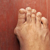 Perlu Tidaknya Pembedahan untuk Bunion