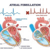 Pedoman Penanganan Atrial Fibrilasi ESC 2024 – Ulasan Guideline Terkini