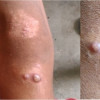 Pemberian Azithromycin Massal untuk Eliminasi Frambusia – Telaah Jurnal