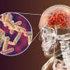 Pedoman Pemberian Kortikosteroid pada Meningitis – Ulasan Guideline Terkini