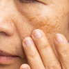 Efektivitas Berbagai Terapi Topikal pada Melasma