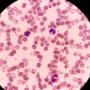Neutropenia Akibat Penggunaan Antipsikotik Clozapine