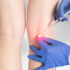 Injeksi Kortikosteroid Vs Dry Needling untuk Nyeri Muskuloskeletal