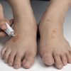 Stop Penggunaan Kortikosteroid untuk Tinea