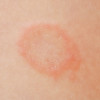 Stop Memberikan Kortikosteroid untuk Dermatofitosis!
