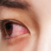 Efikasi Implan Kortikosteroid untuk Uveitis Kronis Non-Infeksi