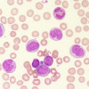 Leukositosis pada Polisitemia Vera