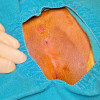 Terapi Endoskopik untuk Sinus Pilonidal