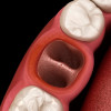 Terapi Topikal pada Osteitis Alveolar atau Dry Socket