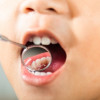Silver Diamine Fluoride Tidak Efektif Mencegah Karies