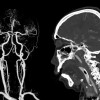 CT Angiografi Diperluas vs CT Angiografi Standar dalam Penatalaksanaan Stroke Iskemik – Telaah Jurnal Alomedika