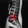 Peran Endoscopic Lumbar Discectomy pada Hernia Nukleus Pulposus Lumbar