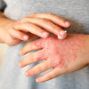 Perbandingan Agen Topikal untuk Penatalaksanaan Dermatitis Atopik
