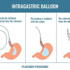 Balon Intragastrik untuk Menurunkan Berat Badan pada Obesitas