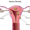 Disparitas Multidimensional dalam Pemanfaatan Uterine Fibroid Embolization pada Fibroid Uterus – Telaah Jurnal Alomedika