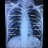 Interpretasi Rontgen Toraks